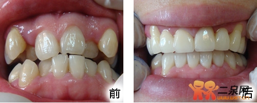 牙齿正畸得<em>拔牙</em>吗?-无锡论坛-无锡门户网-二泉