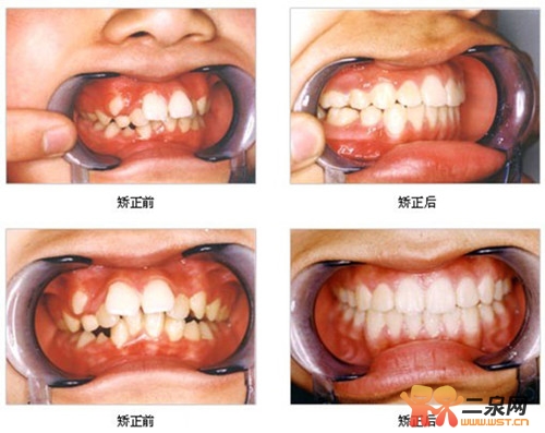 儿童牙齿矫正对比 儿童牙齿矫正对比